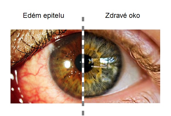 keratitis-2