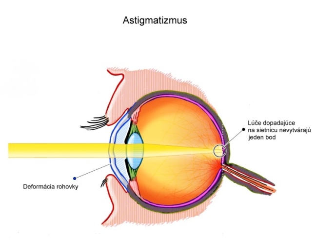 astigmatizmus