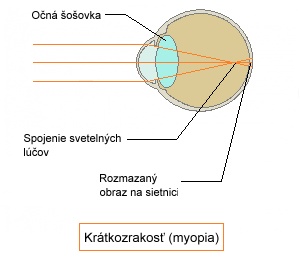 krátkozrakosť